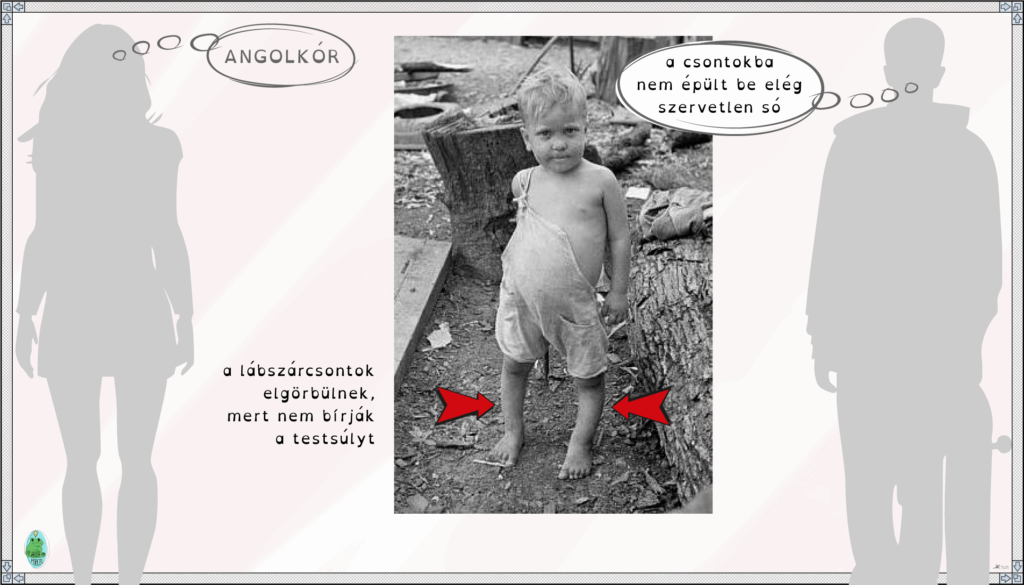 Alultáplált angolkórban szenvedő gyermek egy Missisipi állambeli gyapotfarmon (1935)